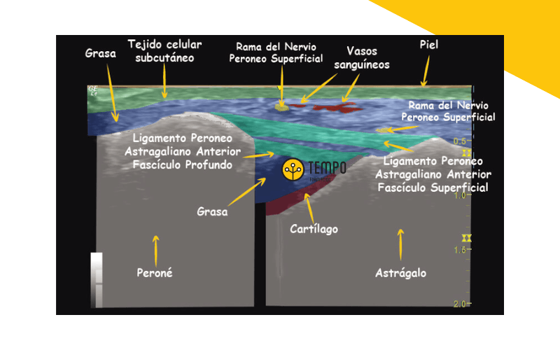 Ligamento peroneo astragalino anterior ecografia tempo formacion anatomia.png